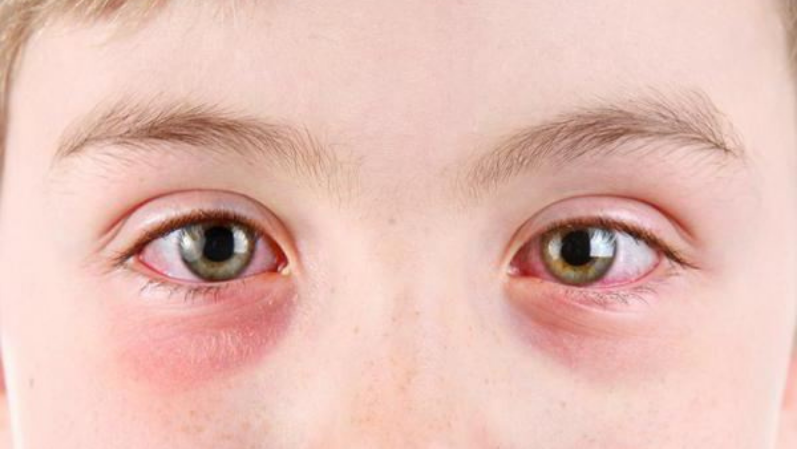 Pollinosis. Allergic eye damage